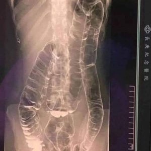 Severe Constipation and Toxic Megacolon: Causes and Solutions