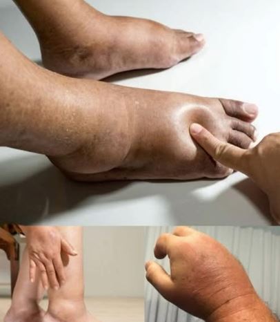 The Best Foods to Help Reduce Swollen Hands and Feet Naturally